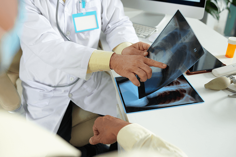 radiografía de pulmones relacionado con enfermedad de la legionella